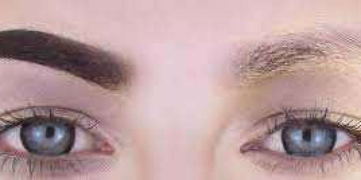 Eyebrow Hair Transplant Palm Desert