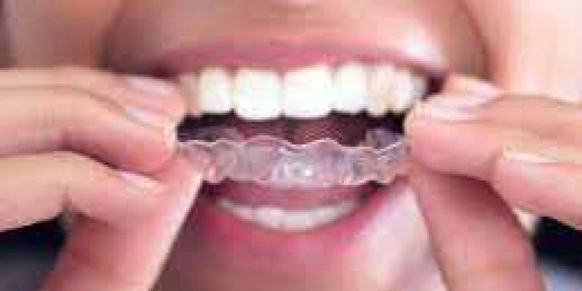 What Are The Benefits Of Invisalign For Kids In Houston, TX?