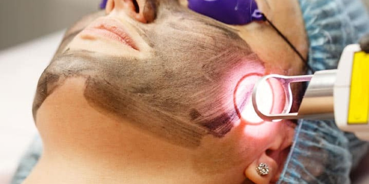 Carbon Laser Treatment in Chandigarh: Dr. Ishaa Junejaa Aesthetics