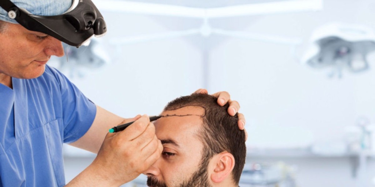 Celebrity Hair Transplants