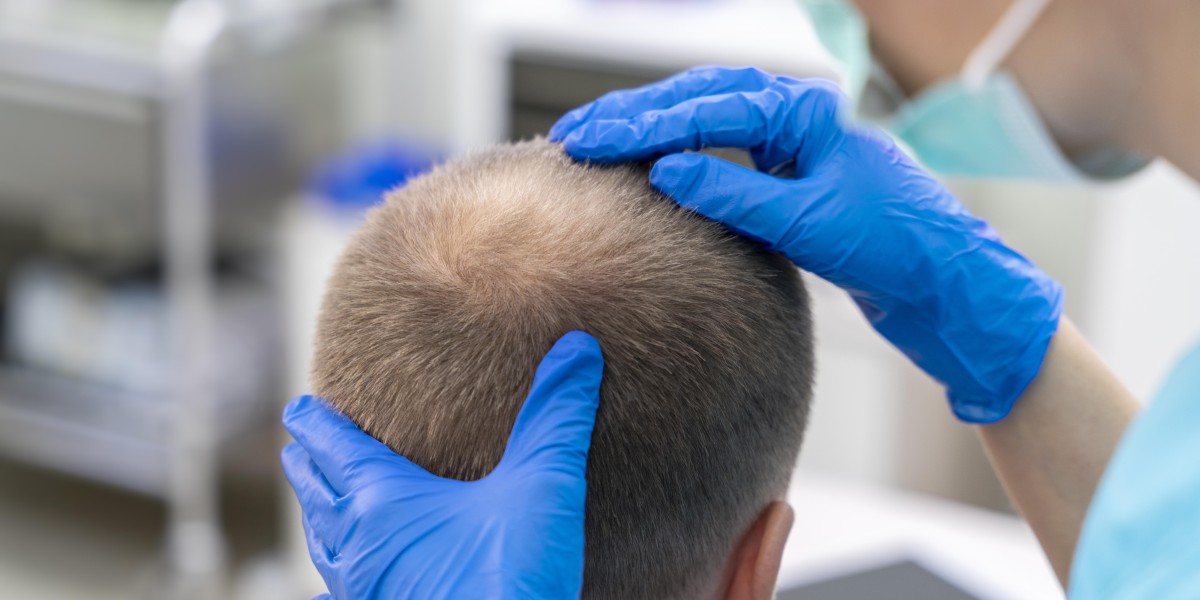 The Benefits Of Getting A Hair Transplant In Beverly Hills