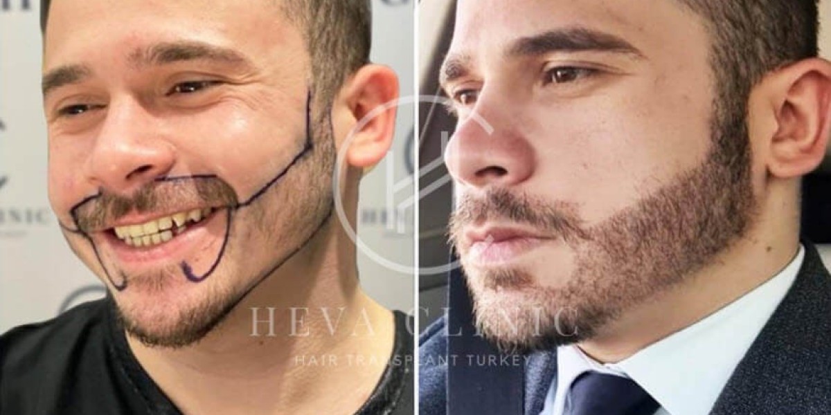 Facial Hair Transplant in Bengaluru