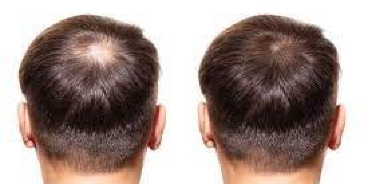 costo del trasplante de cabello fut