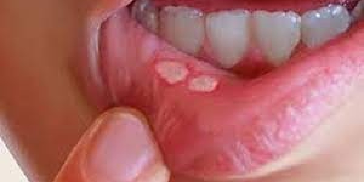 Integrating Ayurveda with Modern Dentistry in Oral Cancer Treatment