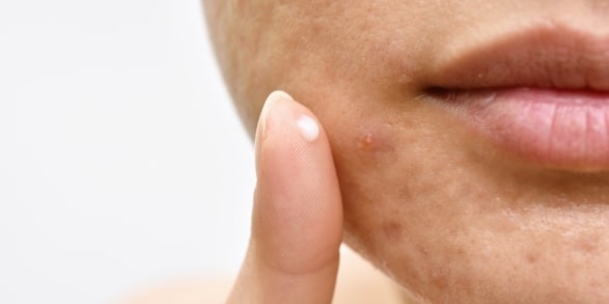 Best Acne Treatment Clinic in Dwarka