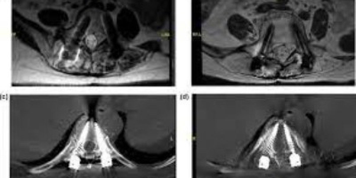 Spinal Implants Material Market Soars $2893.56 Million by 2030