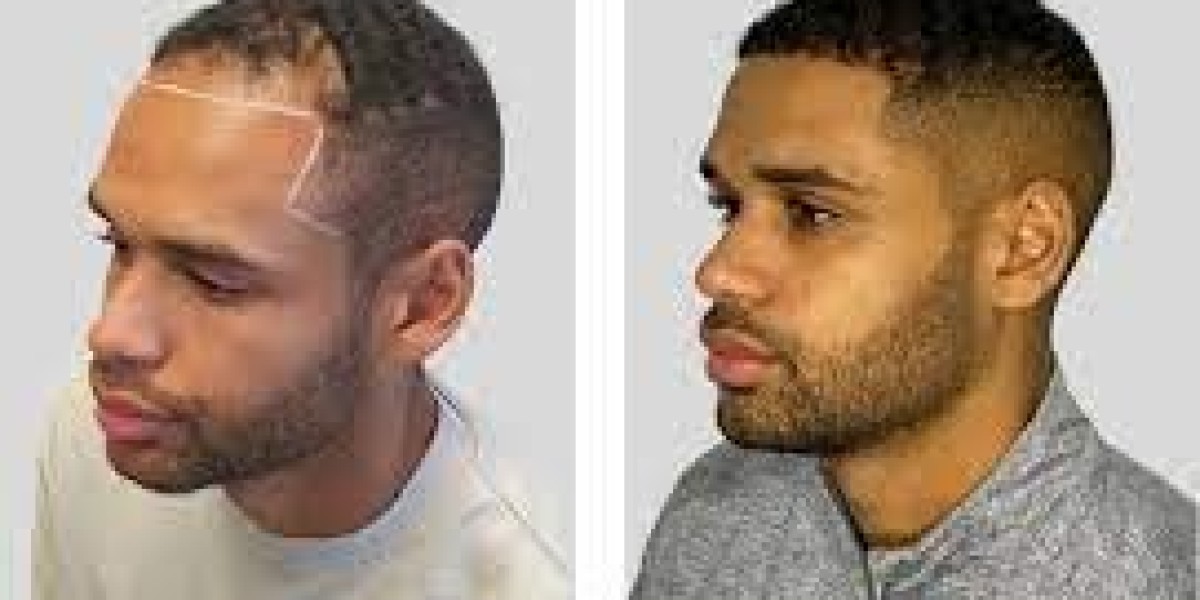 Unlocking Confidence: A Comprehensive Guide to Hair Transplants in Pakistan