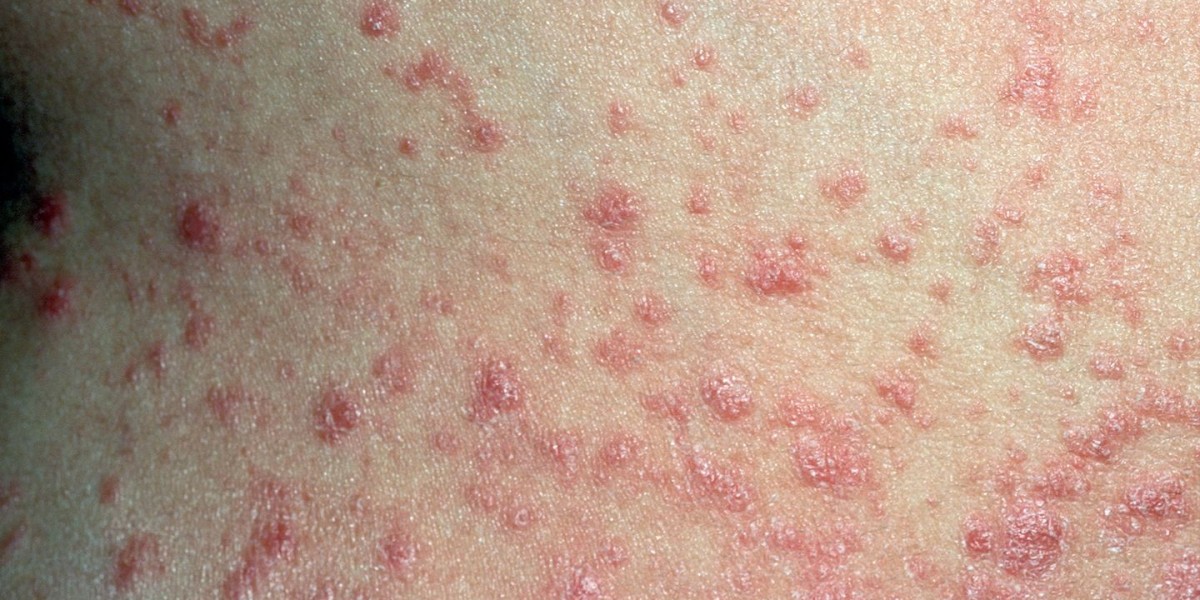 Unlocking Clear Skin: A Comprehensive Guide to Guttate Psoriasis Treatment with Kayakalp
