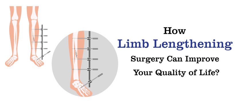 How Limb Lengthening Surgery Can Improve Your Quality of Life - Global Healthcare India