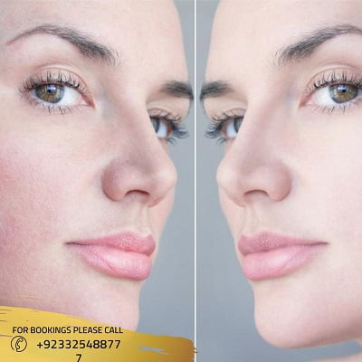 Glutathione Skin Whitening Injections in Islamabad Pakistan