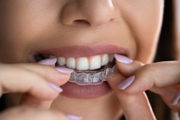 Invisalign Treatment for Crooked Teeth in Rochester NY