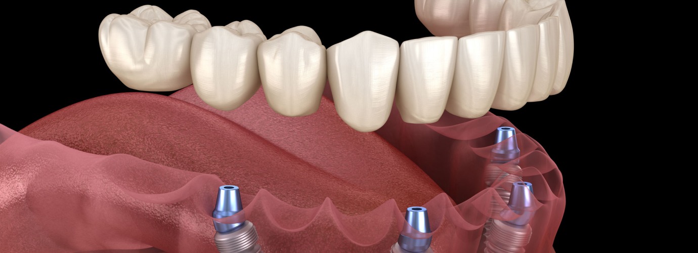 The Benefits of Choosing Dental Implants in Melbourne for Missing Teeth