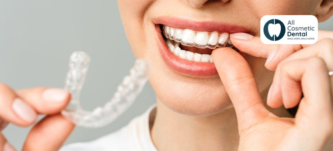 Custom vs. Store-Bought Night Guards: Choosing the Right Protection for Teeth Grinding