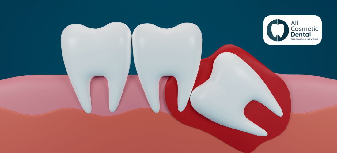 Wisdom Teeth Removal: Pros, Cons​, and Procedure
