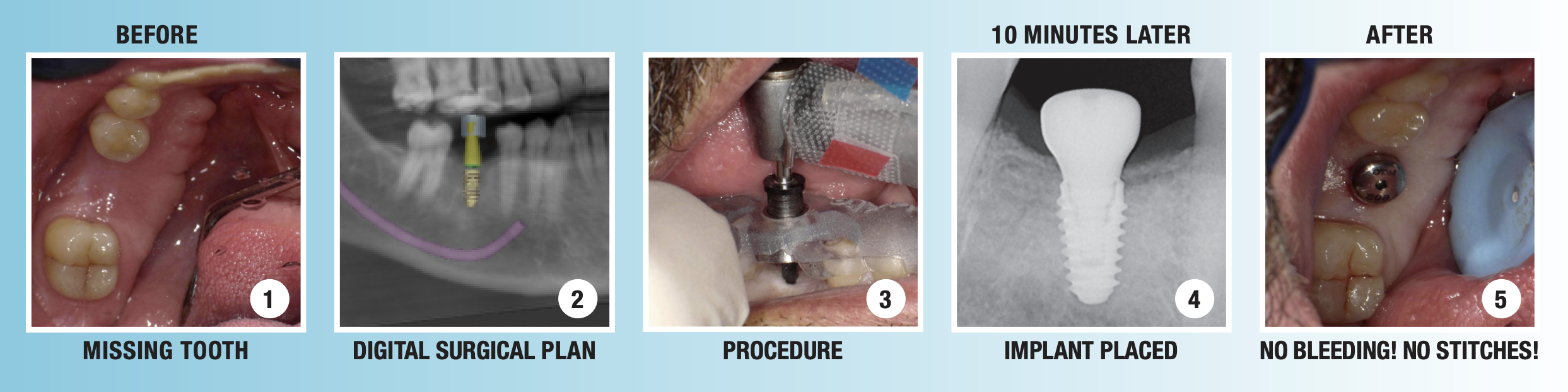 Computer-Guided Dental Implant Surgery – Perdido Bay Dental