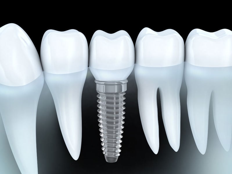 Implant Dentistry | Full Dental Implants in Pensacola, FL