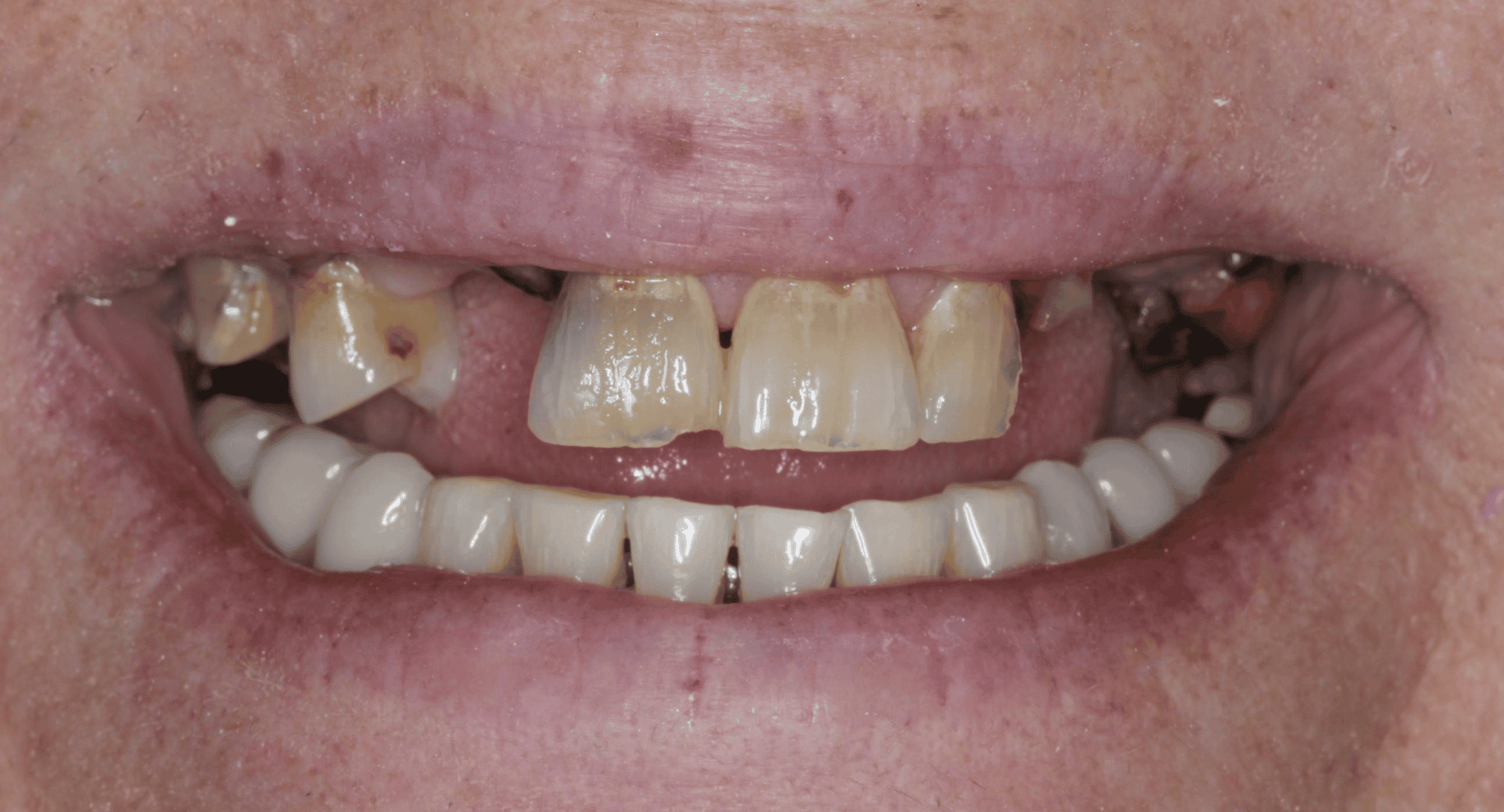 Professional Dental Implant in Houston | URBN Dental