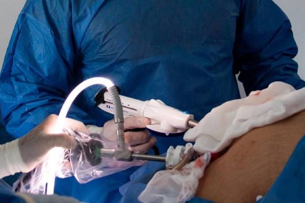 Appendix Surgery | Appendix Treatment in Hyderabad - Dr. N. Subrahmaneswara Babu