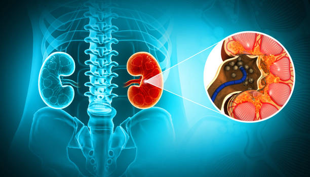 Kidney Stone Specialist in Ahmedabad | Dr. Vineet Ajitsaria