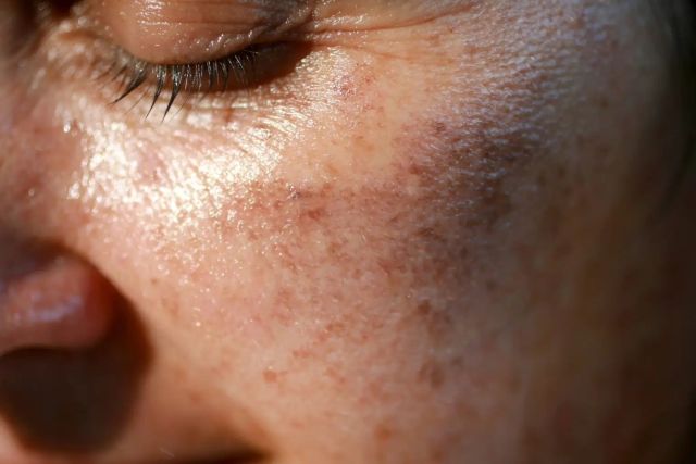 From Sun-Kissed Glow to Dark Spots: How Summer Triggers Hyperpigmentation – @dionysioumedispa00 on Tumblr