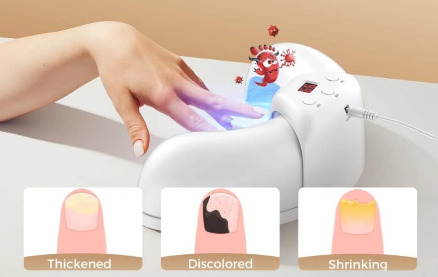 Fungabeam Reviews - Low-Level Laser Therapy (LLLT) Device for Toenail Fungus Relief!