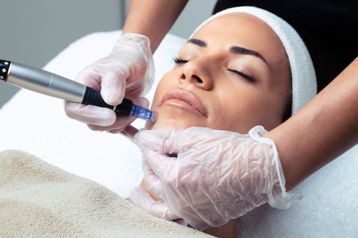 Microneedling Near Me Shoreditch: Where to Book the Best Skin Rejuvenation